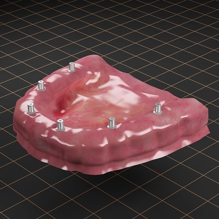 Dental Implant Collection 3D model_19
