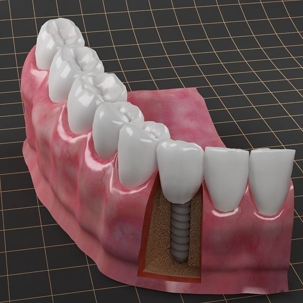 Dental Implant Collection 3D model_12