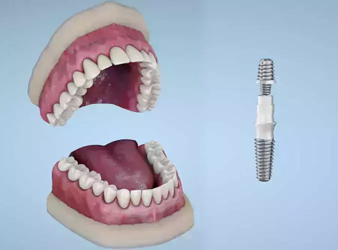 Dental implants 3D model