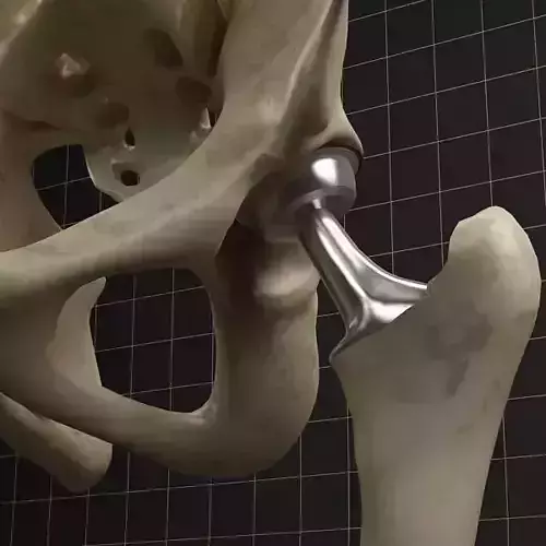 Femoral prosthesis  and  complete skeleton 3D model