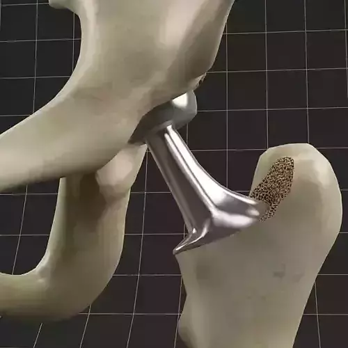 Femoral prosthesis femur and pelvic gilder  3D model