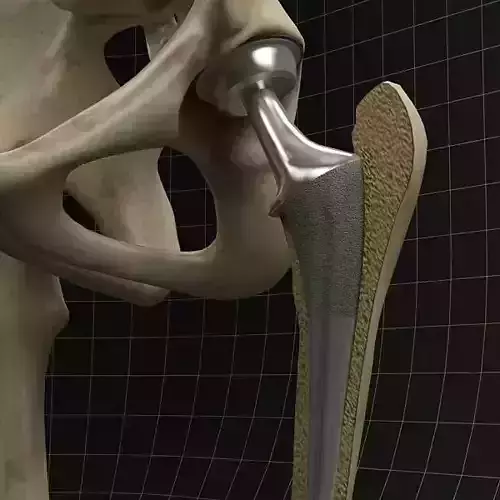 Femoral prosthesis with complete skeleton and section femur 3D model