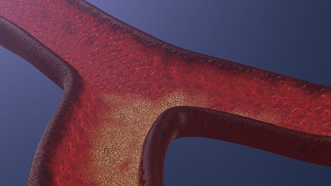 Atherosclerotic Vessel 3d model 3D model