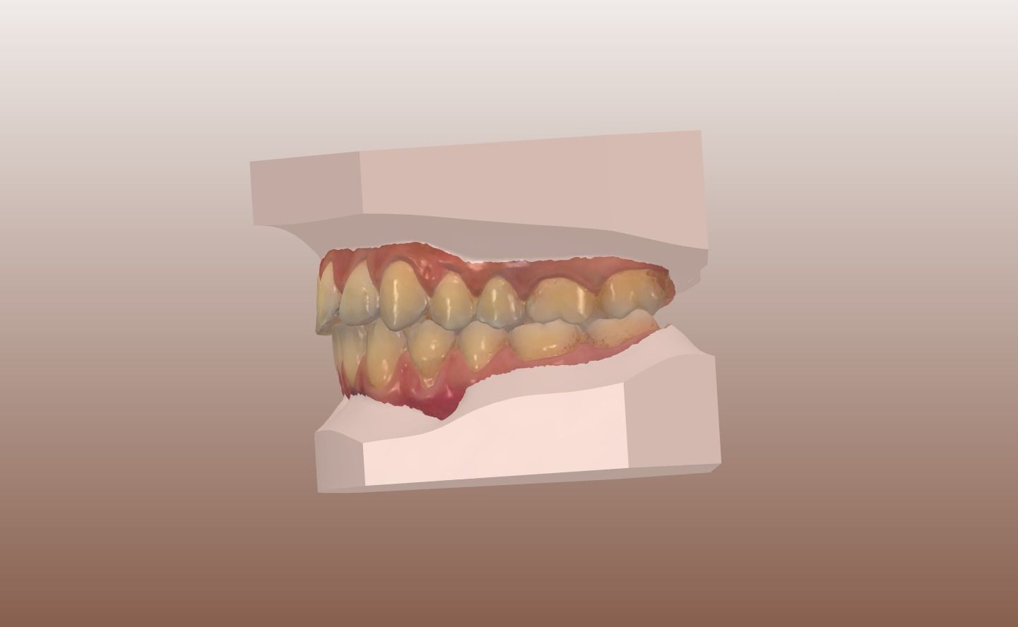 Orthodontic Planning Study Model 3D print model_13