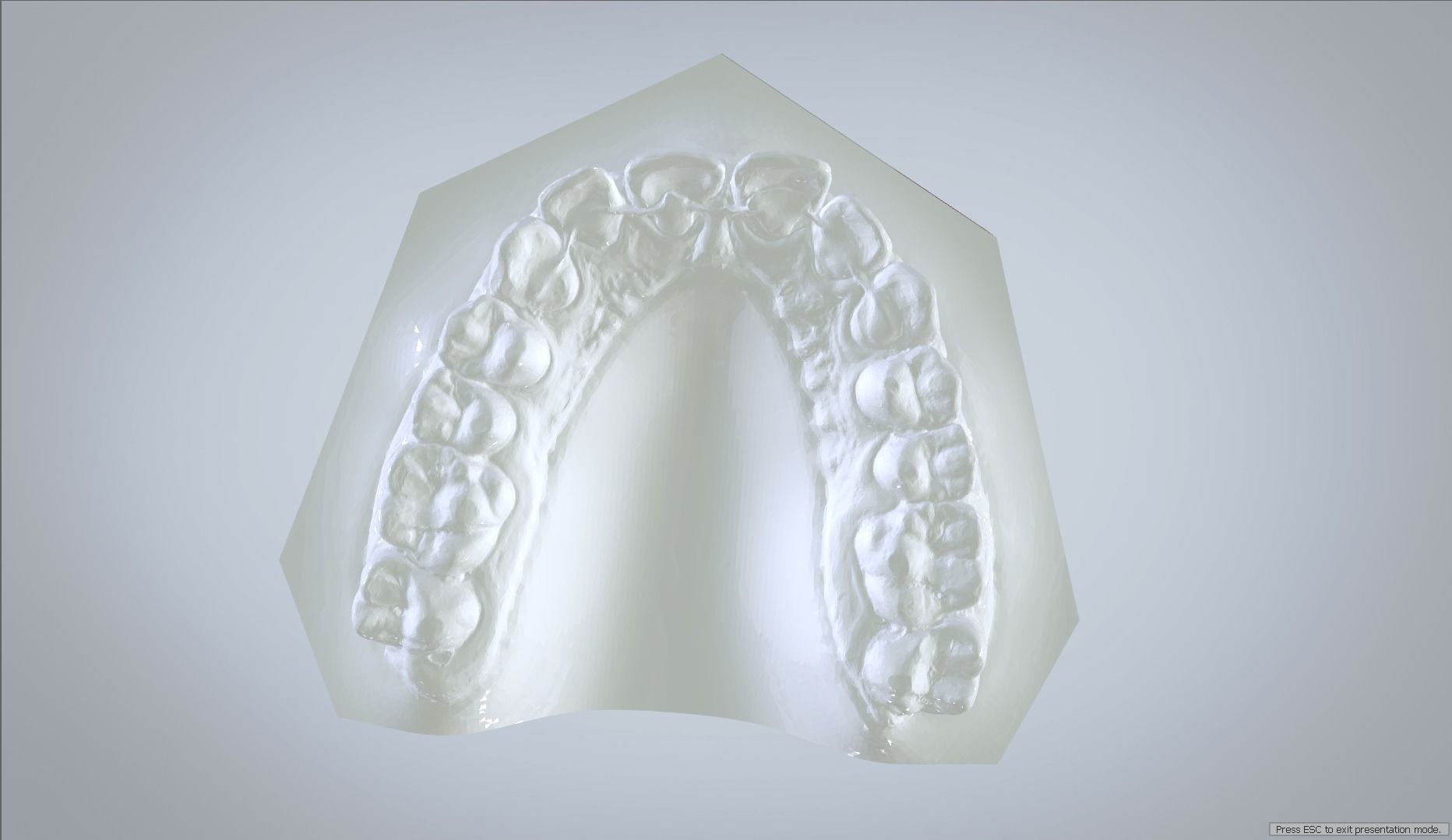 Orthodontic Planning Study Model 3D print model_4