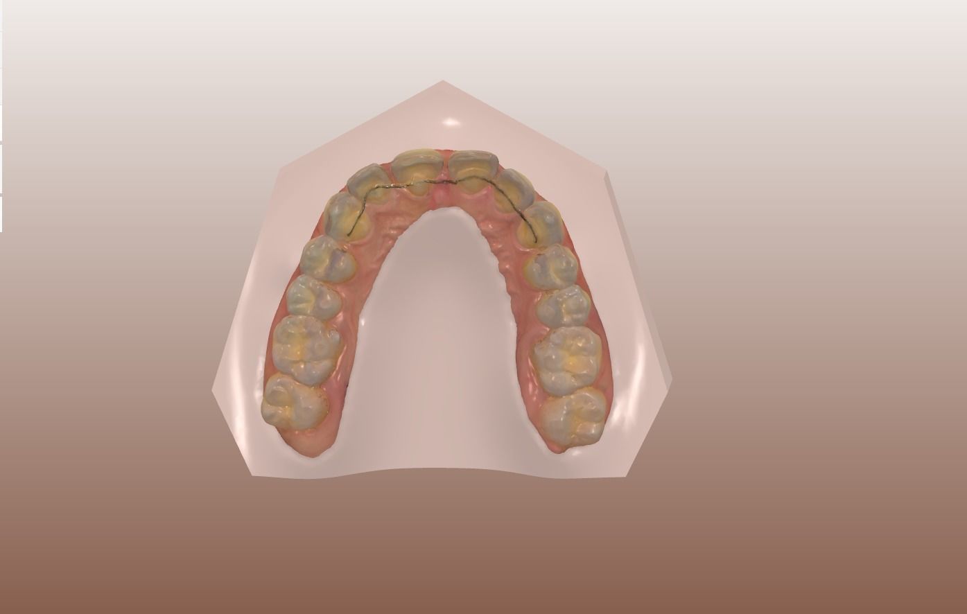 Orthodontic Planning Study Model 3D print model_8
