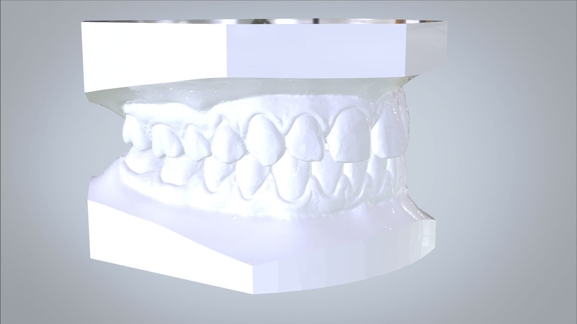 Orthodontic Planning Study Model 3D print model_5