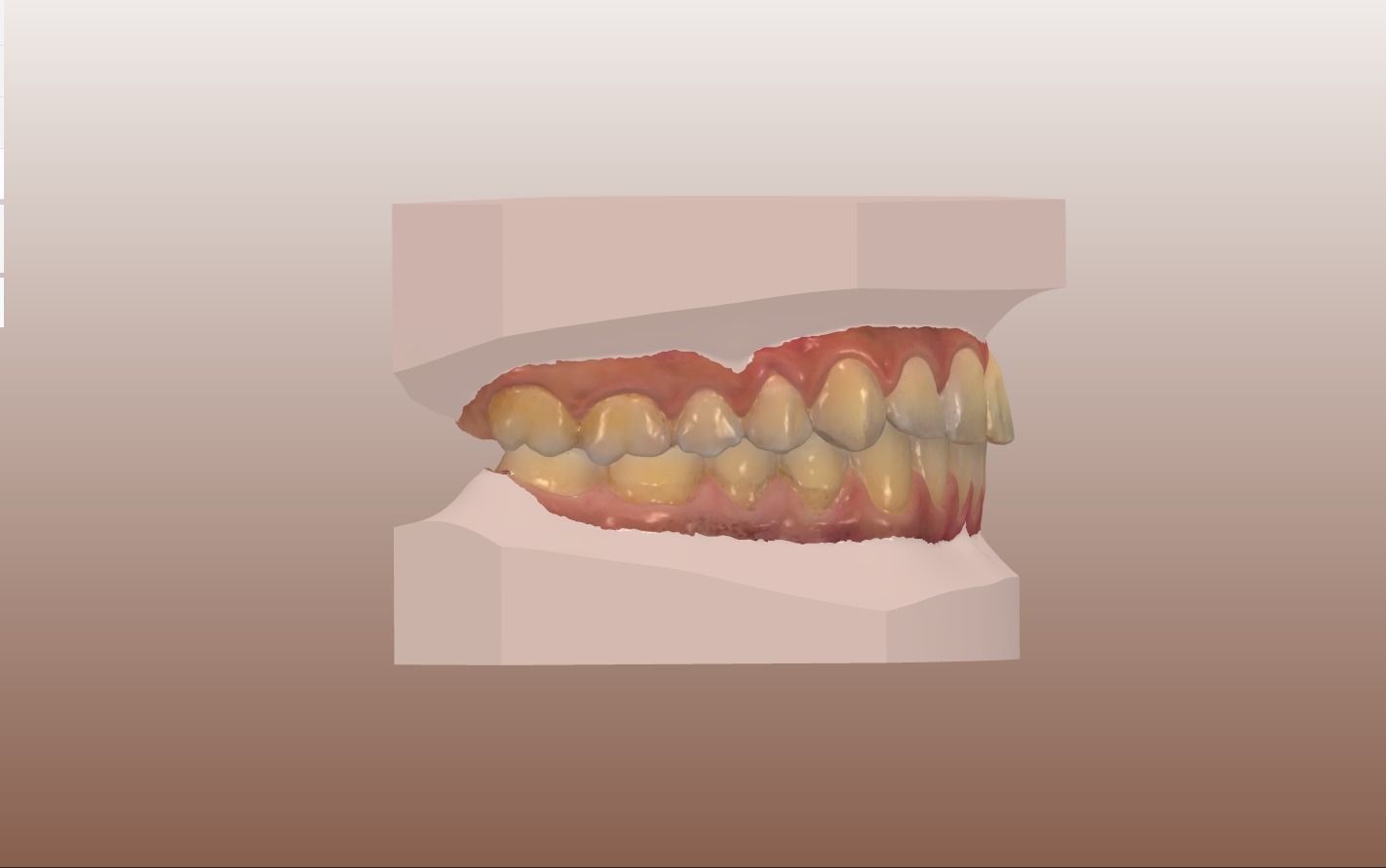 Orthodontic Planning Study Model 3D print model_3
