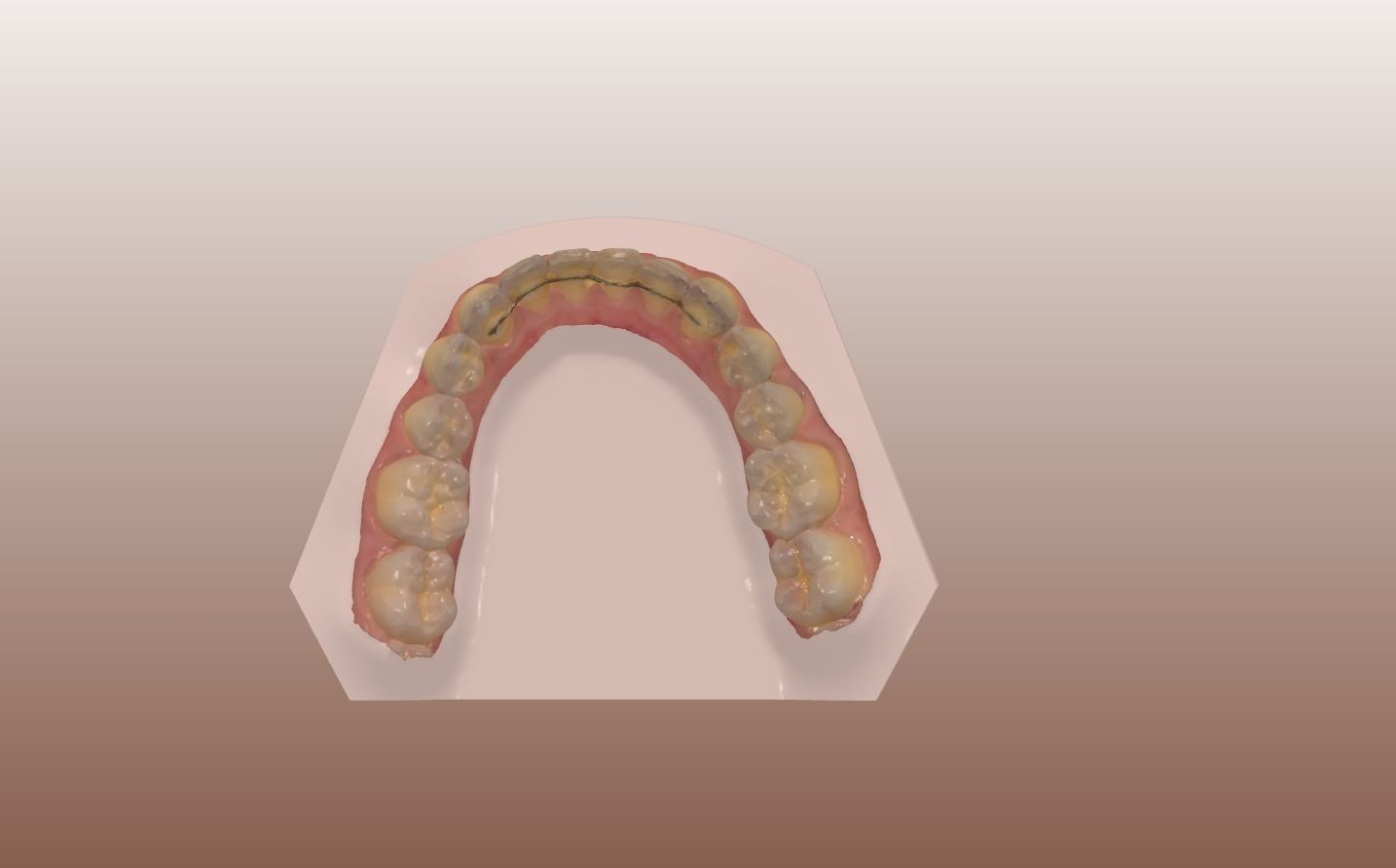 Orthodontic Planning Study Model 3D print model_7
