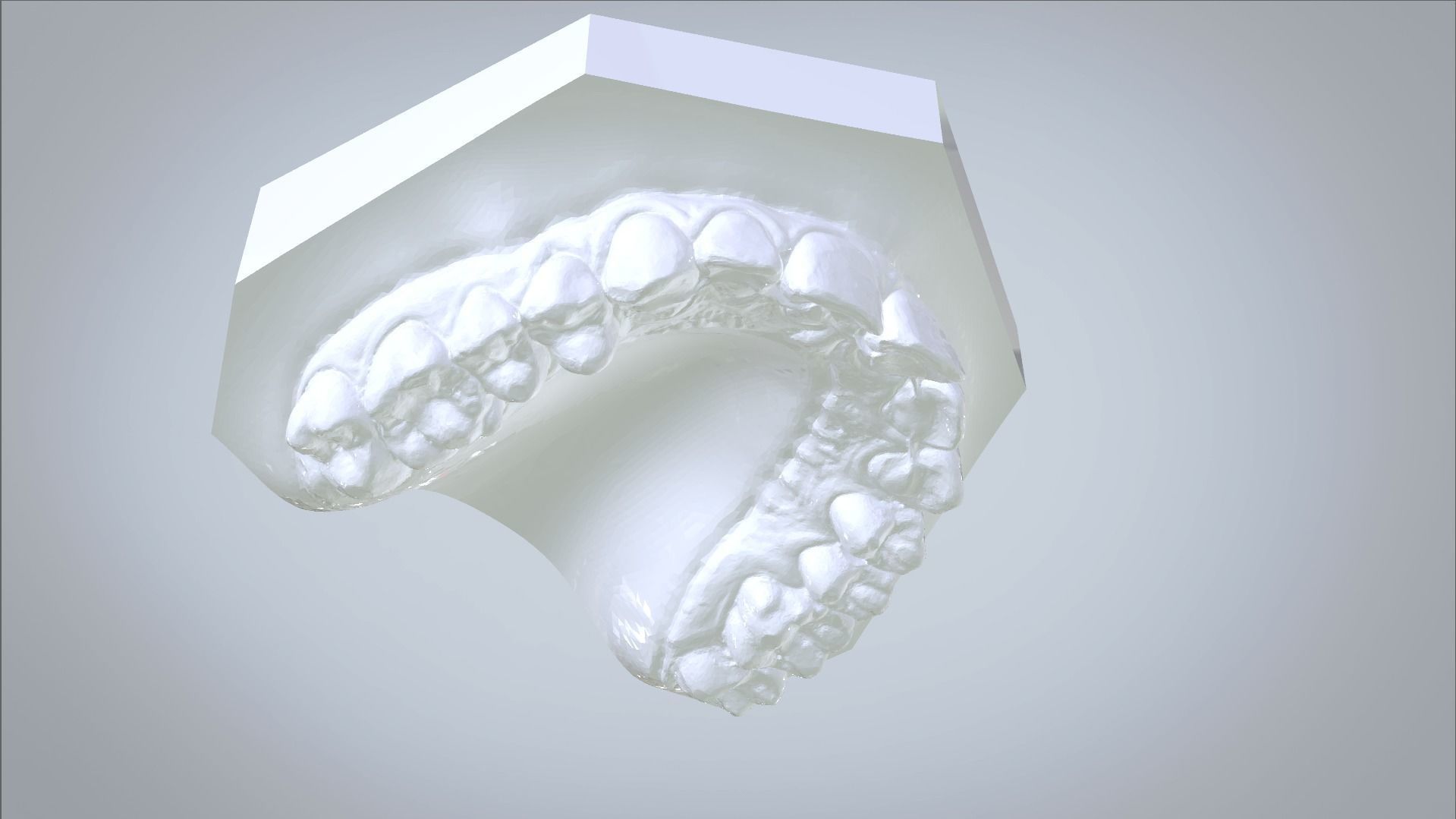 Orthodontic Planning Study Model 3D print model_10