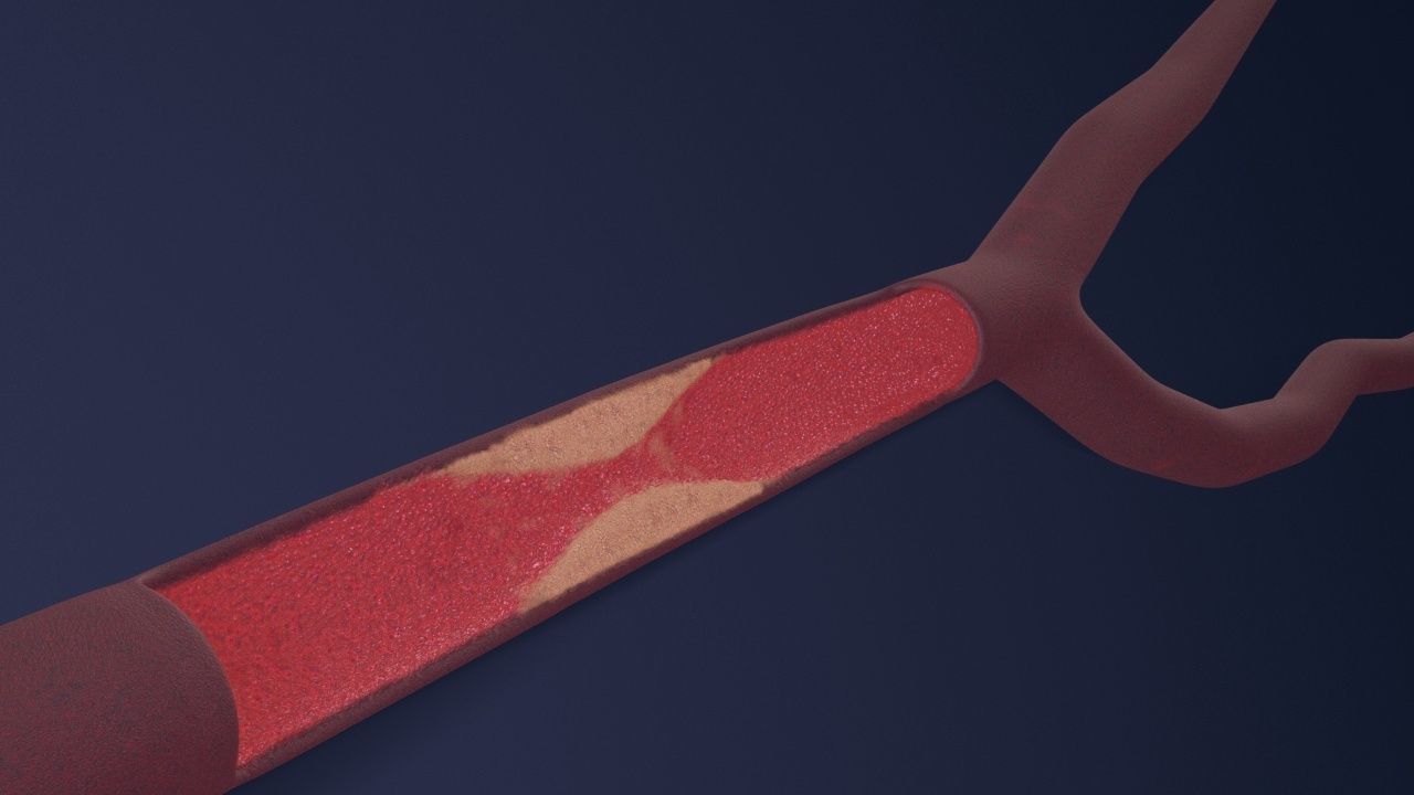 Artery with atherosclerotic plaque 3D model_18
