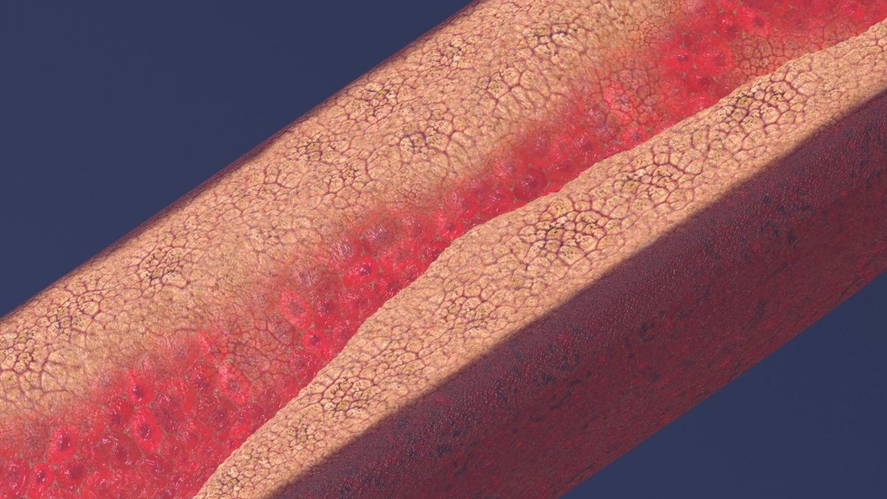 Artery with atherosclerotic plaque 3D model_6