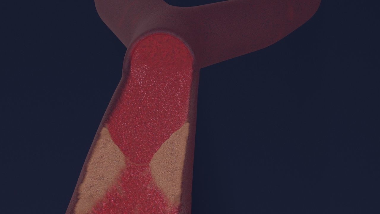 Artery with atherosclerotic plaque 3D model_8