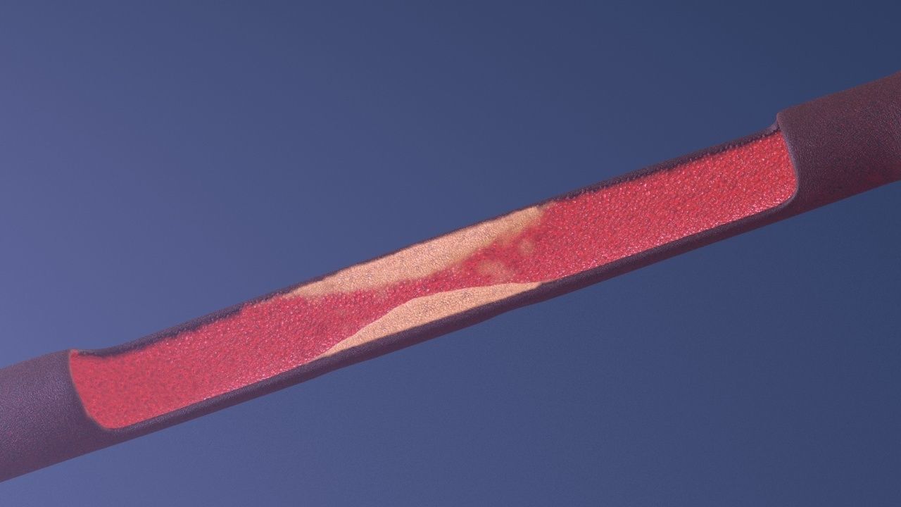 Artery with atherosclerotic plaque 3D model_19