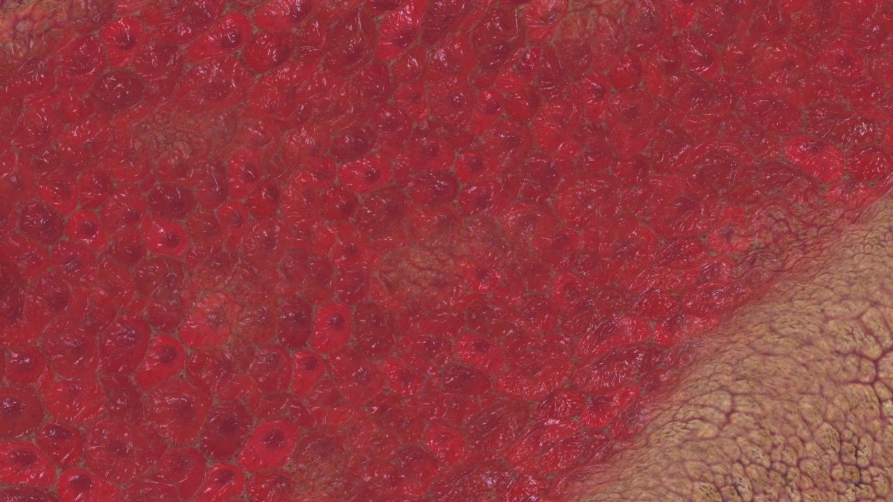 Artery with atherosclerotic plaque 3D model_14