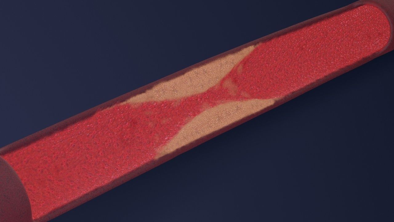 Artery with atherosclerotic plaque 3D model_11