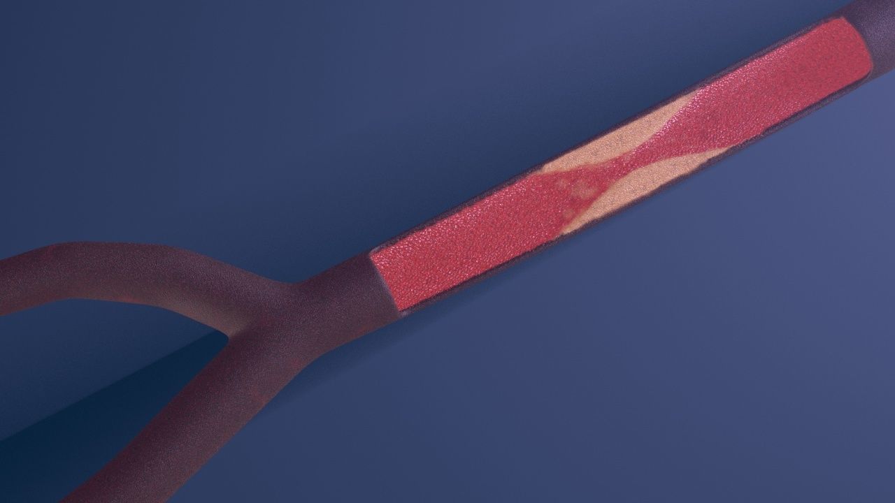 Artery with atherosclerotic plaque 3D model_16