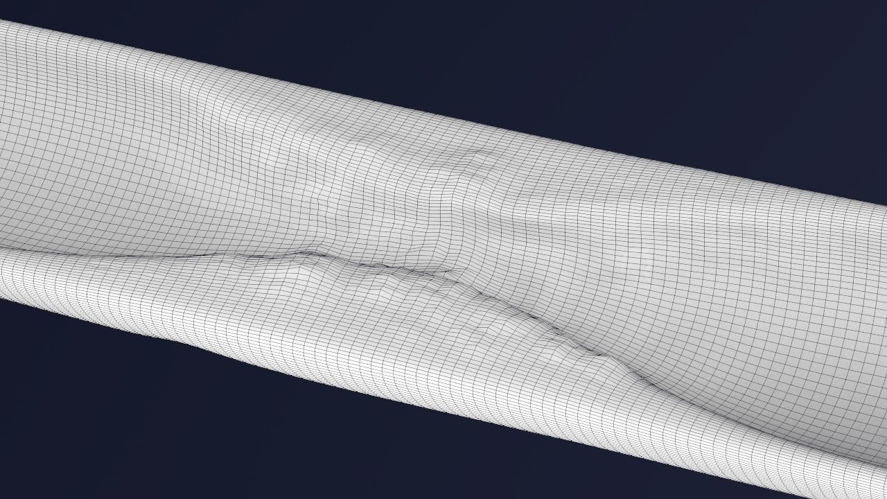 Artery with atherosclerotic plaque 3D model_3