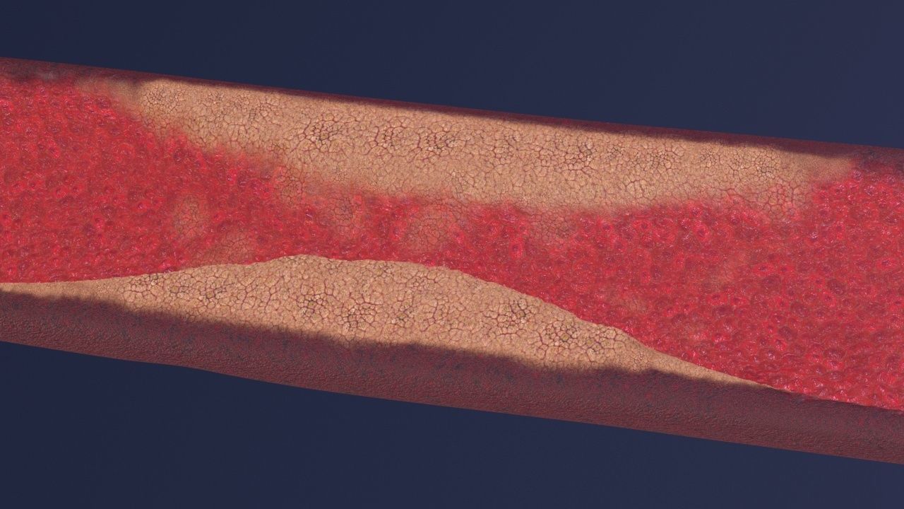 Artery with atherosclerotic plaque 3D model_22