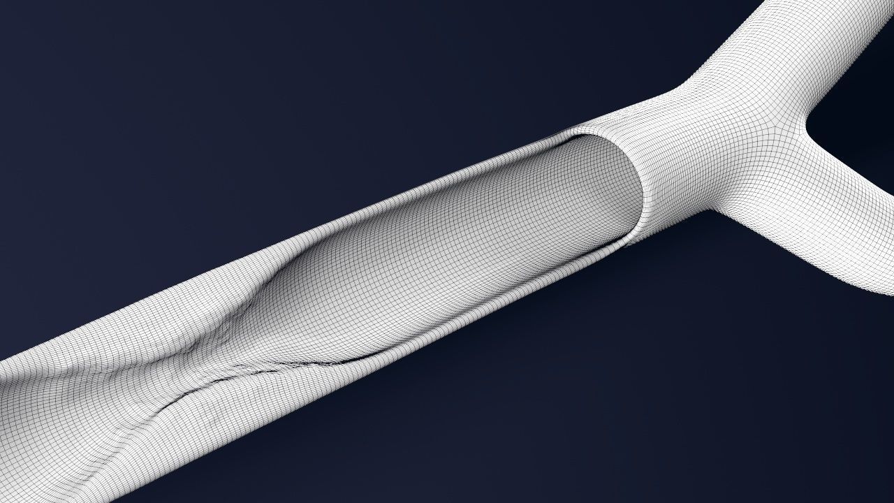 Artery with atherosclerotic plaque 3D model_13