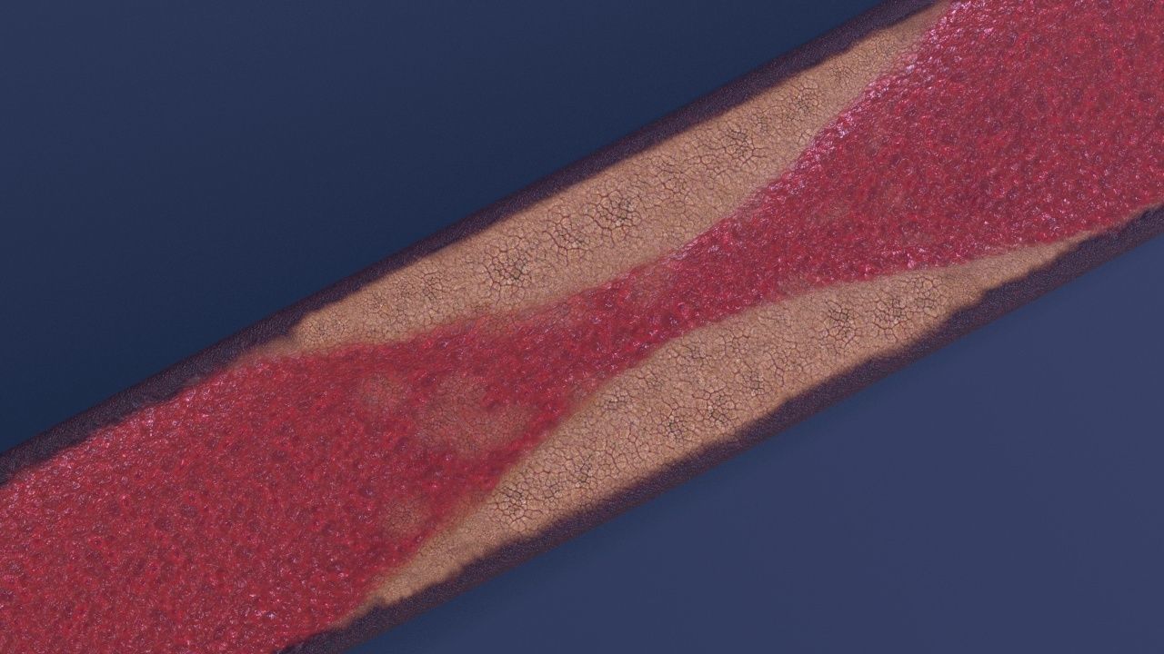 Artery with atherosclerotic plaque 3D model_2