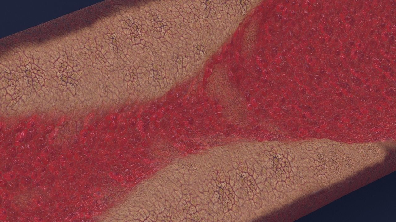Artery with atherosclerotic plaque 3D model_4