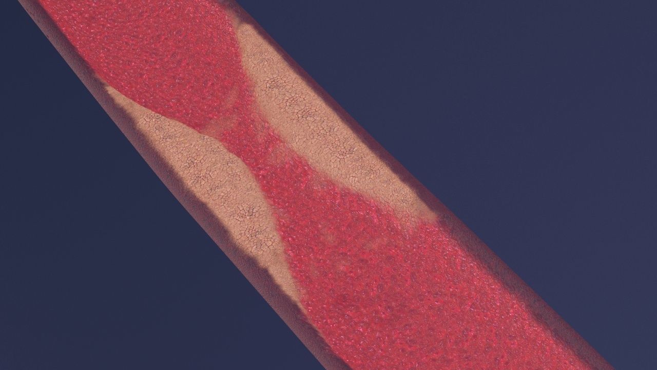 Artery with atherosclerotic plaque 3D model_21