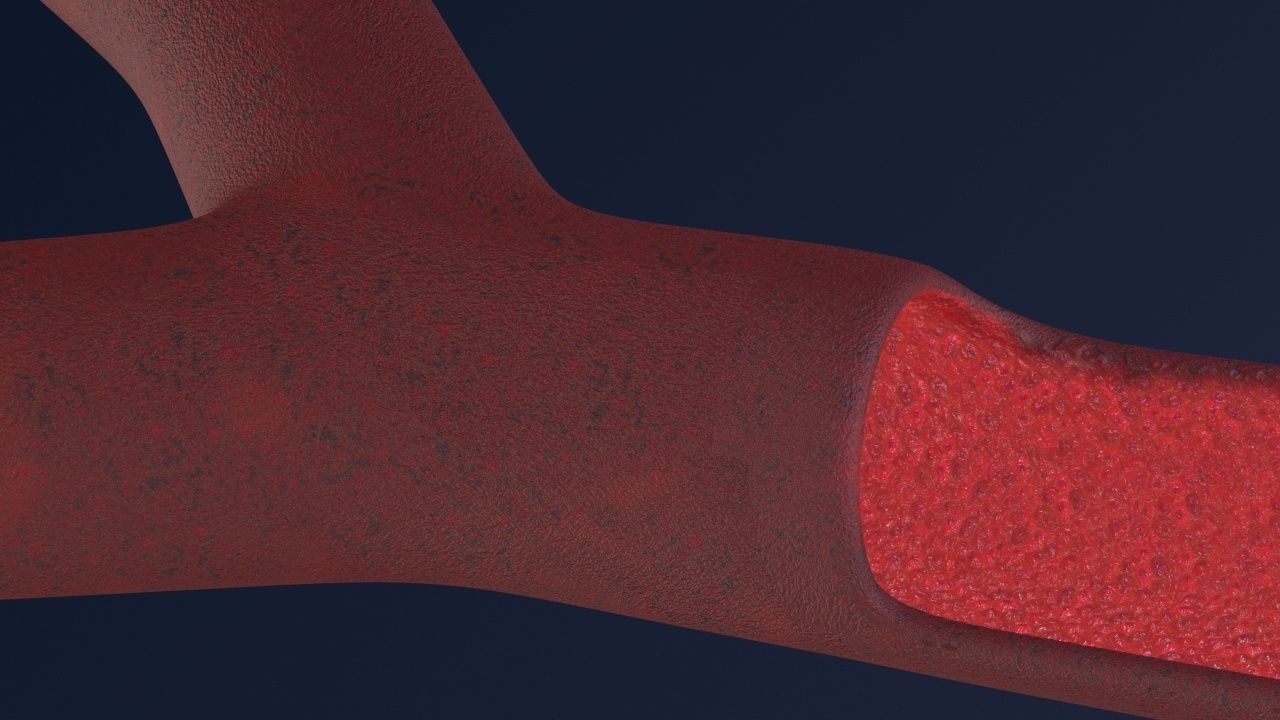 Artery with atherosclerotic plaque 3D model_23
