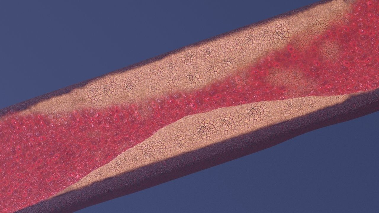 Artery with atherosclerotic plaque 3D model_20