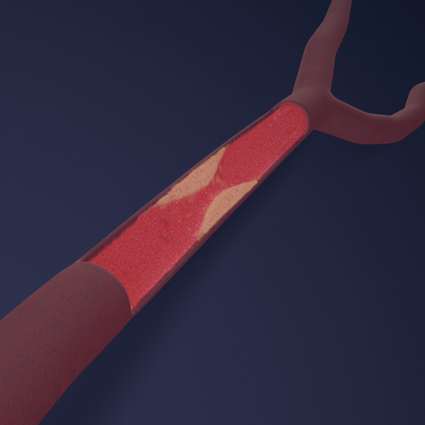 Artery with atherosclerotic plaque 3D model_0