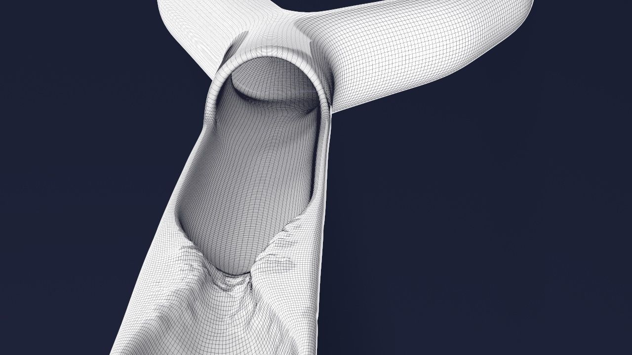 Artery with atherosclerotic plaque 3D model_9