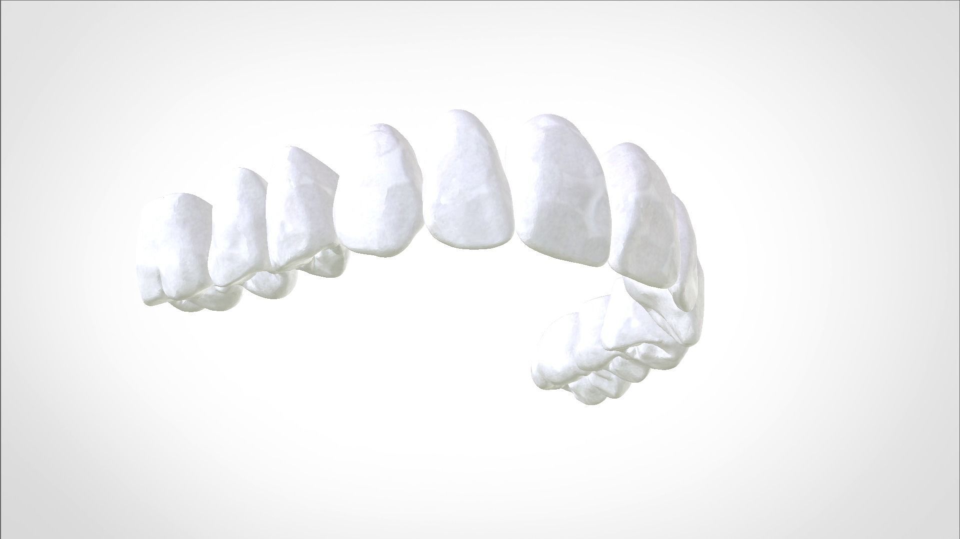 Digital Full Dentures for Gluedin Teeth with Manual Reduction 3D print model_20