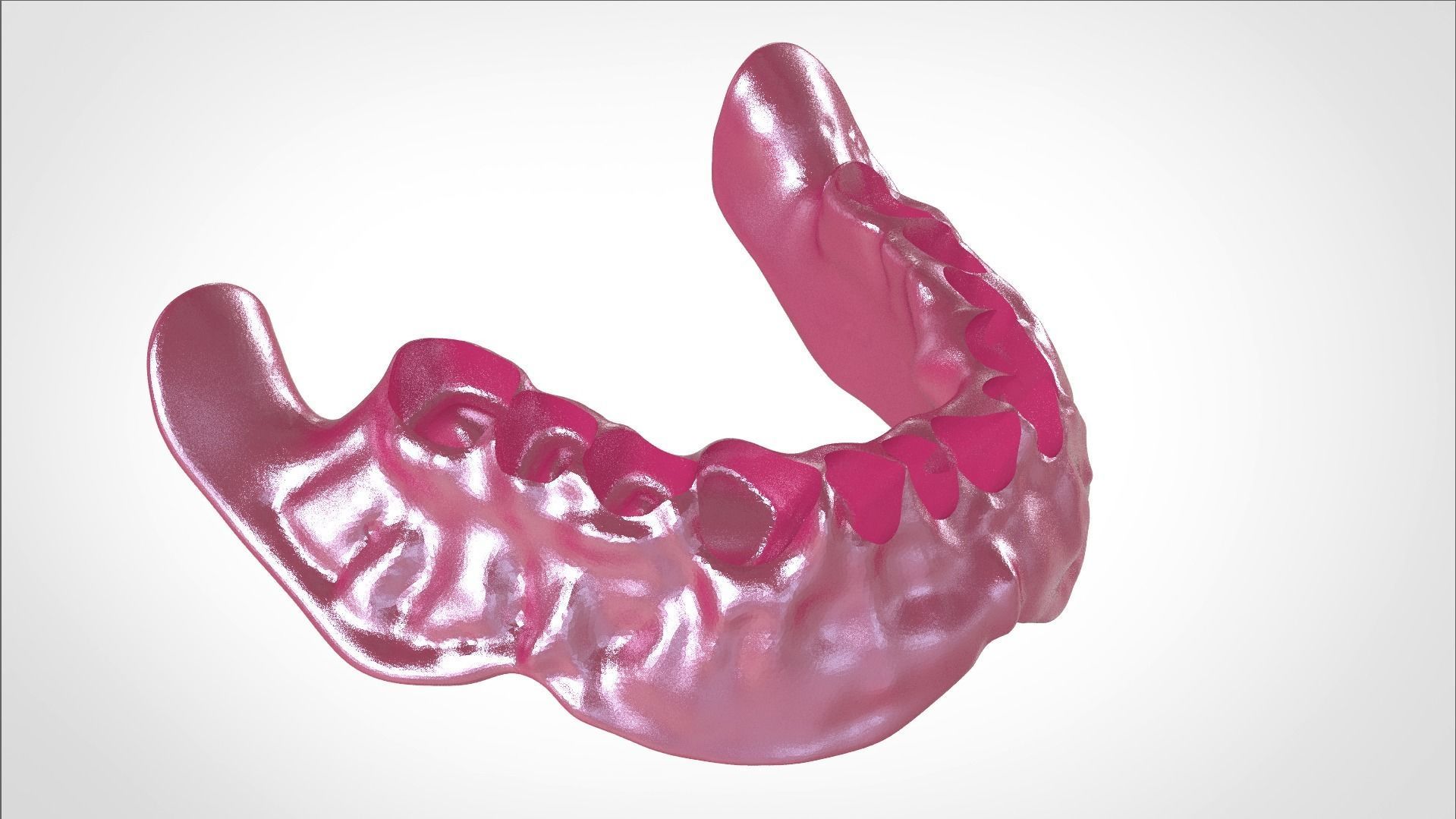 Digital Full Dentures for Gluedin Teeth with Manual Reduction 3D print model_32