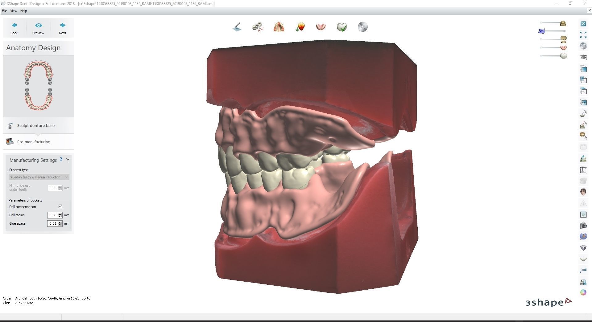 Digital Full Dentures for Gluedin Teeth with Manual Reduction 3D print model_15