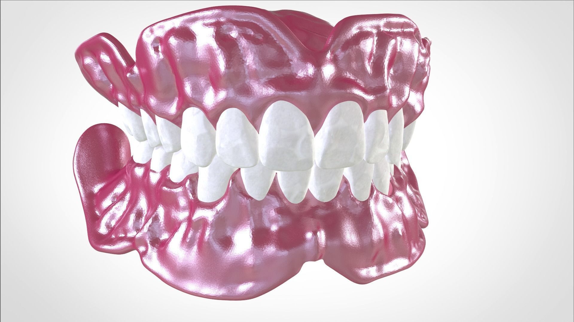 Digital Full Dentures for Gluedin Teeth with Manual Reduction 3D print model_23