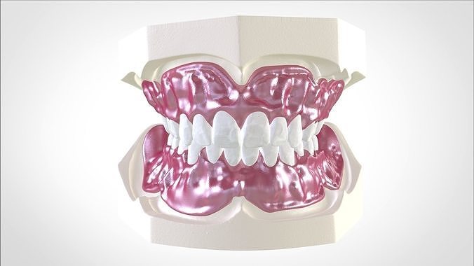 Digital Full Dentures for Gluedin Teeth with Manual Reduction 3D print model