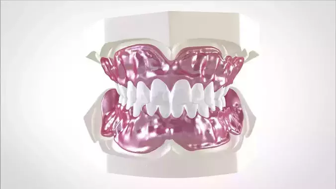Digital Full Dentures for Gluedin Teeth with Manual Reduction
