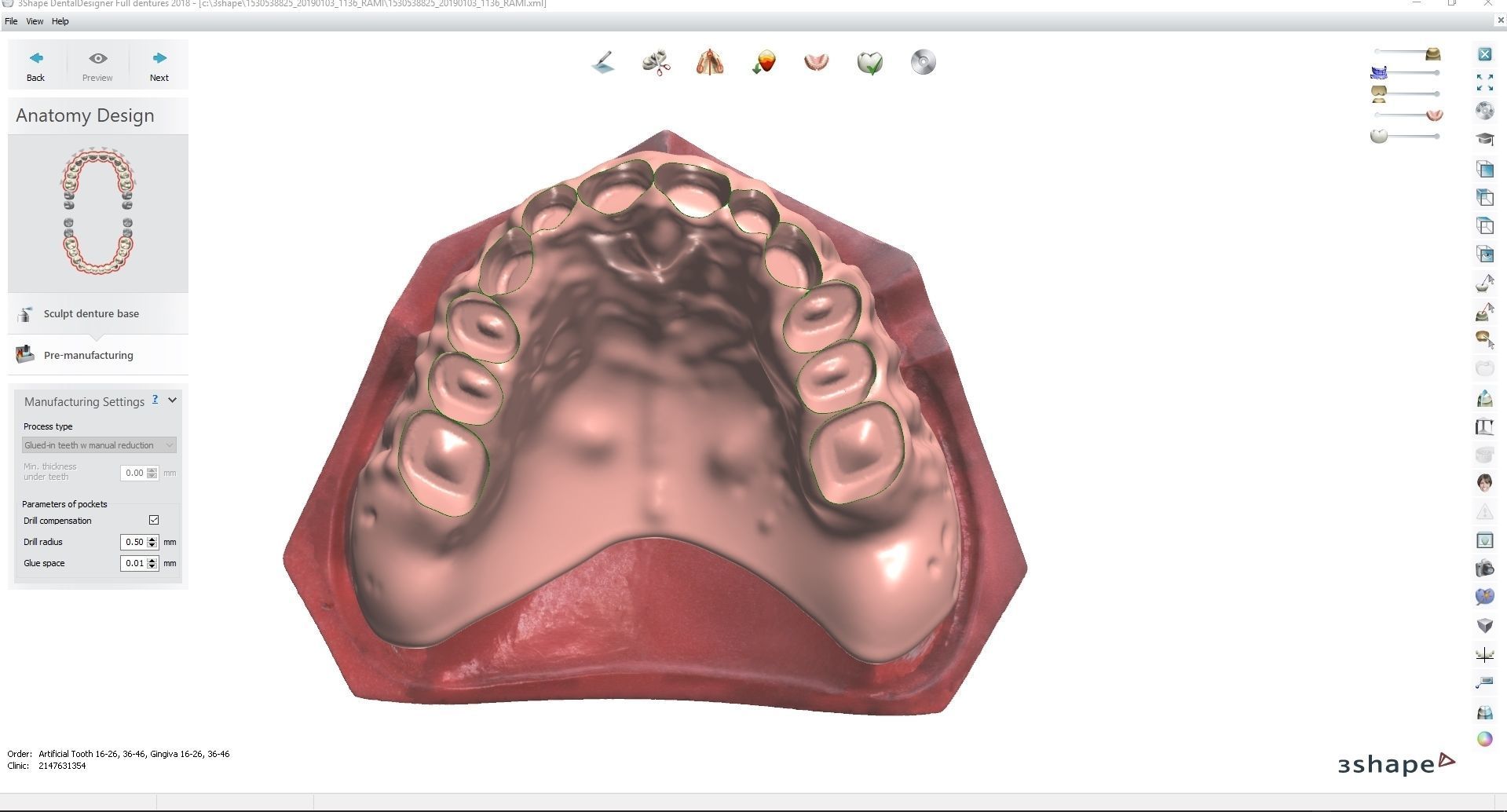 Digital Full Dentures for Gluedin Teeth with Manual Reduction 3D print model_17