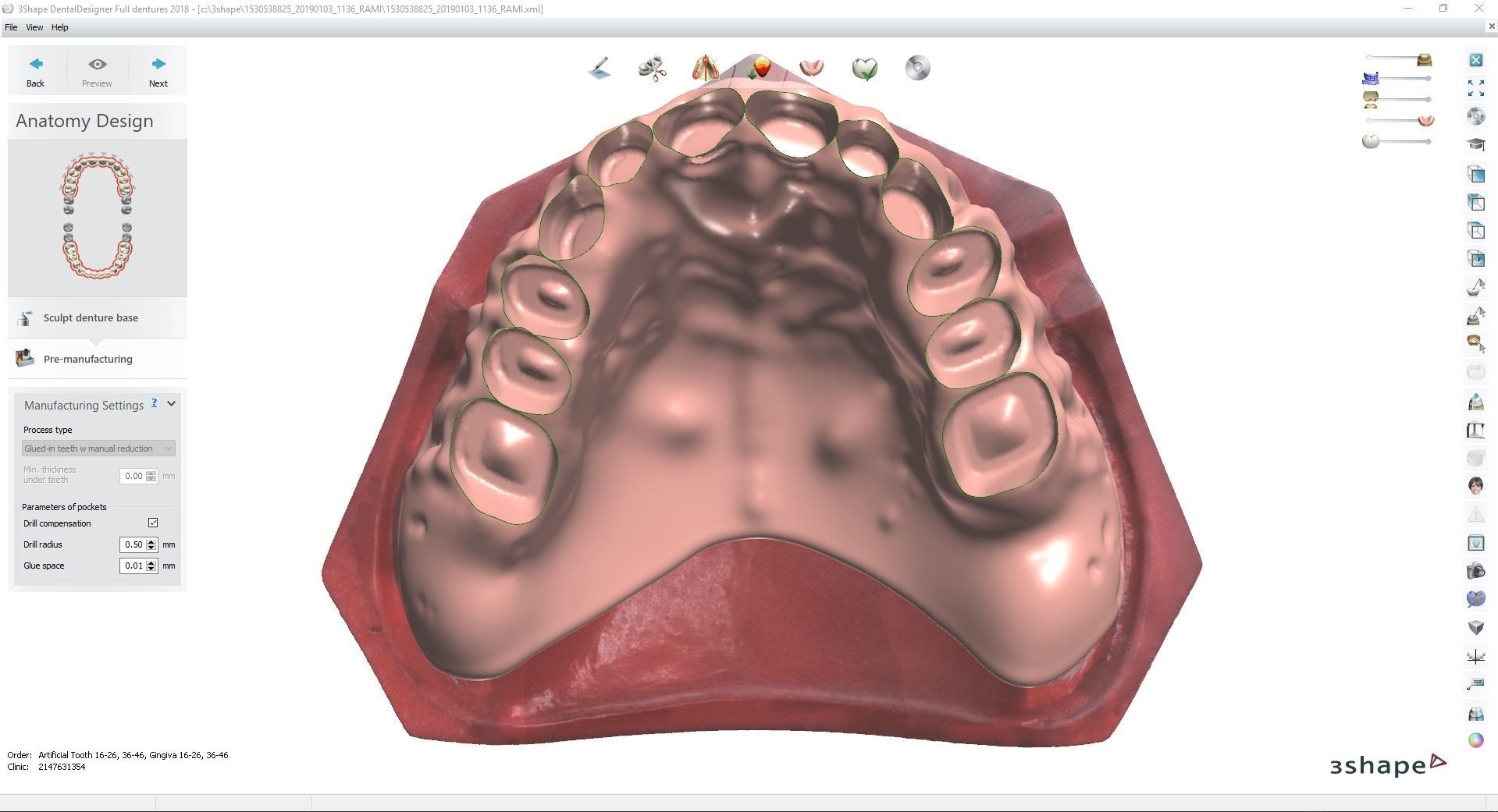 Digital Full Dentures for Gluedin Teeth with Manual Reduction 3D print model_16