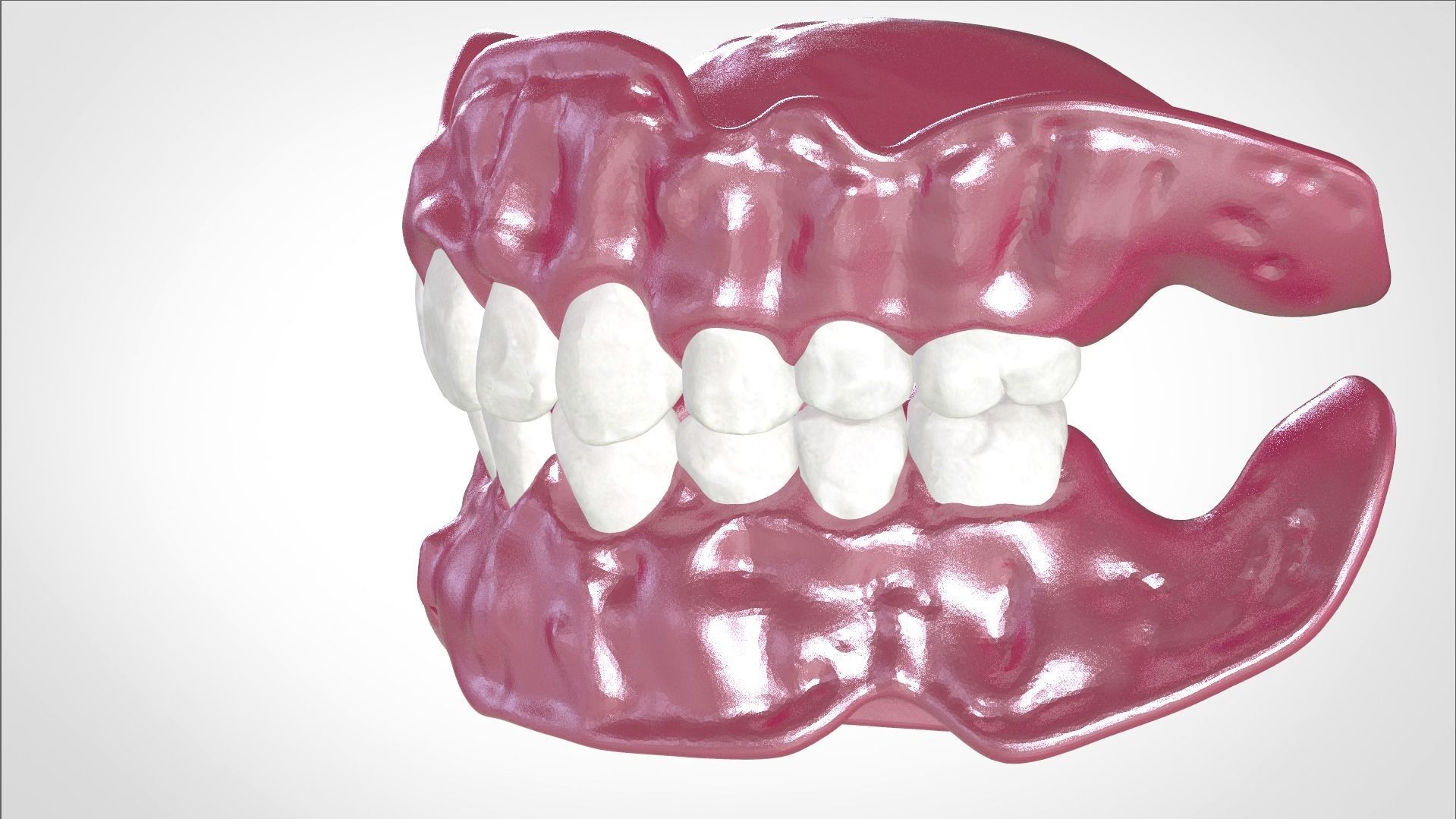 Digital Full Dentures for Gluedin Teeth with Manual Reduction 3D print model_25