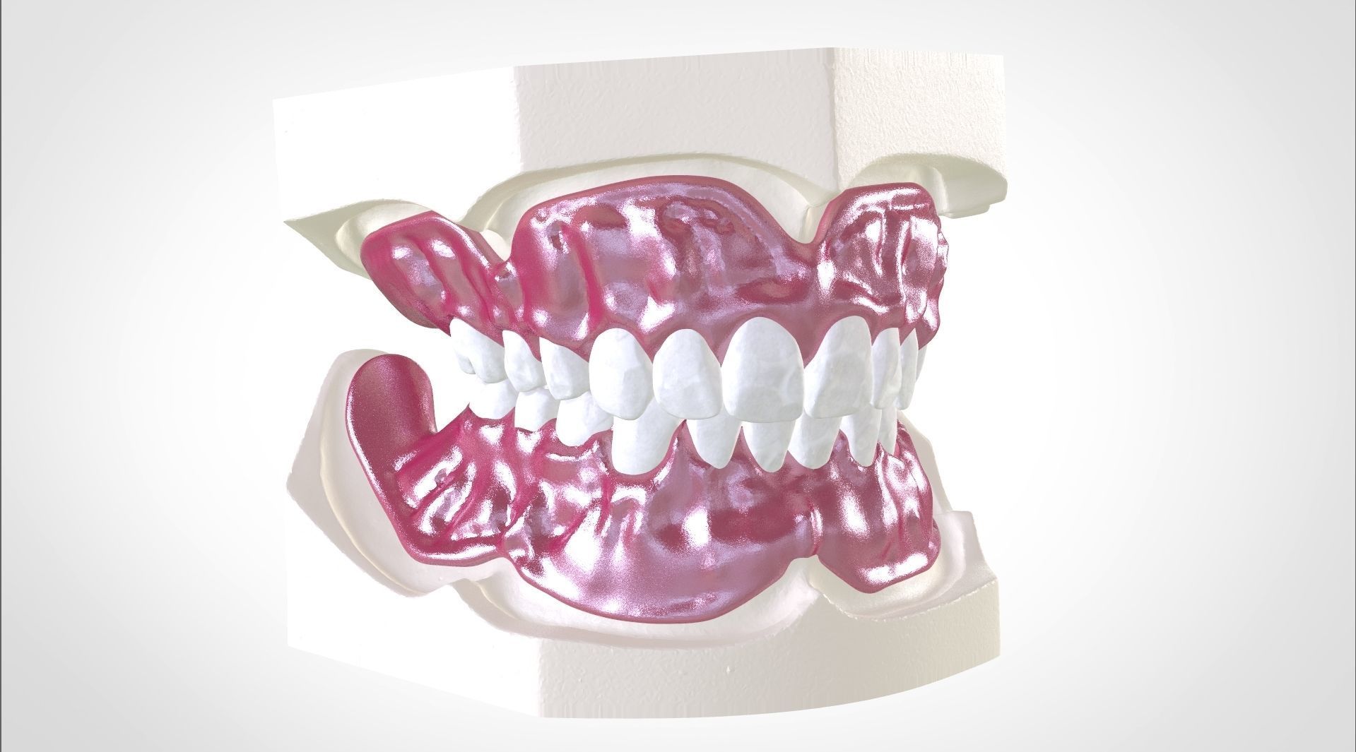 Digital Full Dentures for Gluedin Teeth with Manual Reduction 3D print model_5