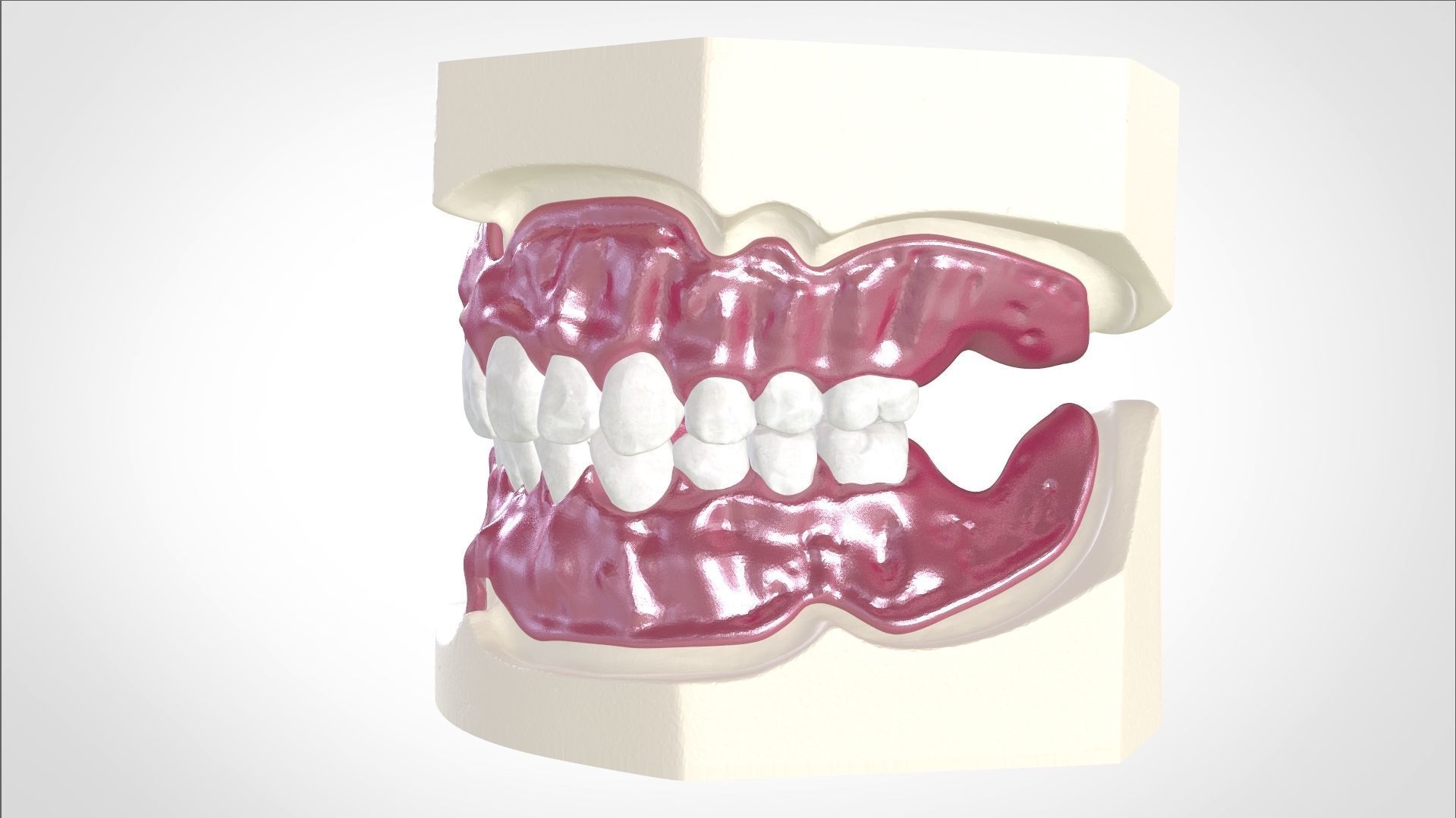 Digital Full Dentures for Gluedin Teeth with Manual Reduction 3D print model_8