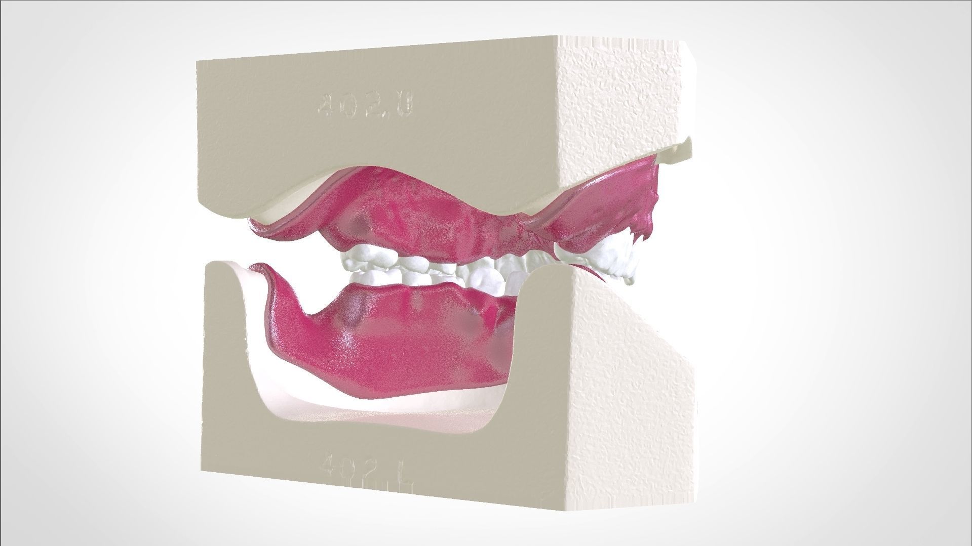 Digital Full Dentures for Gluedin Teeth with Manual Reduction 3D print model_6