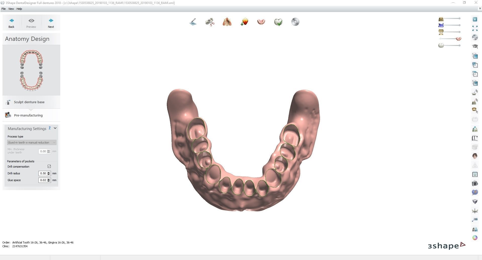 Digital Full Dentures for Gluedin Teeth with Manual Reduction 3D print model_4