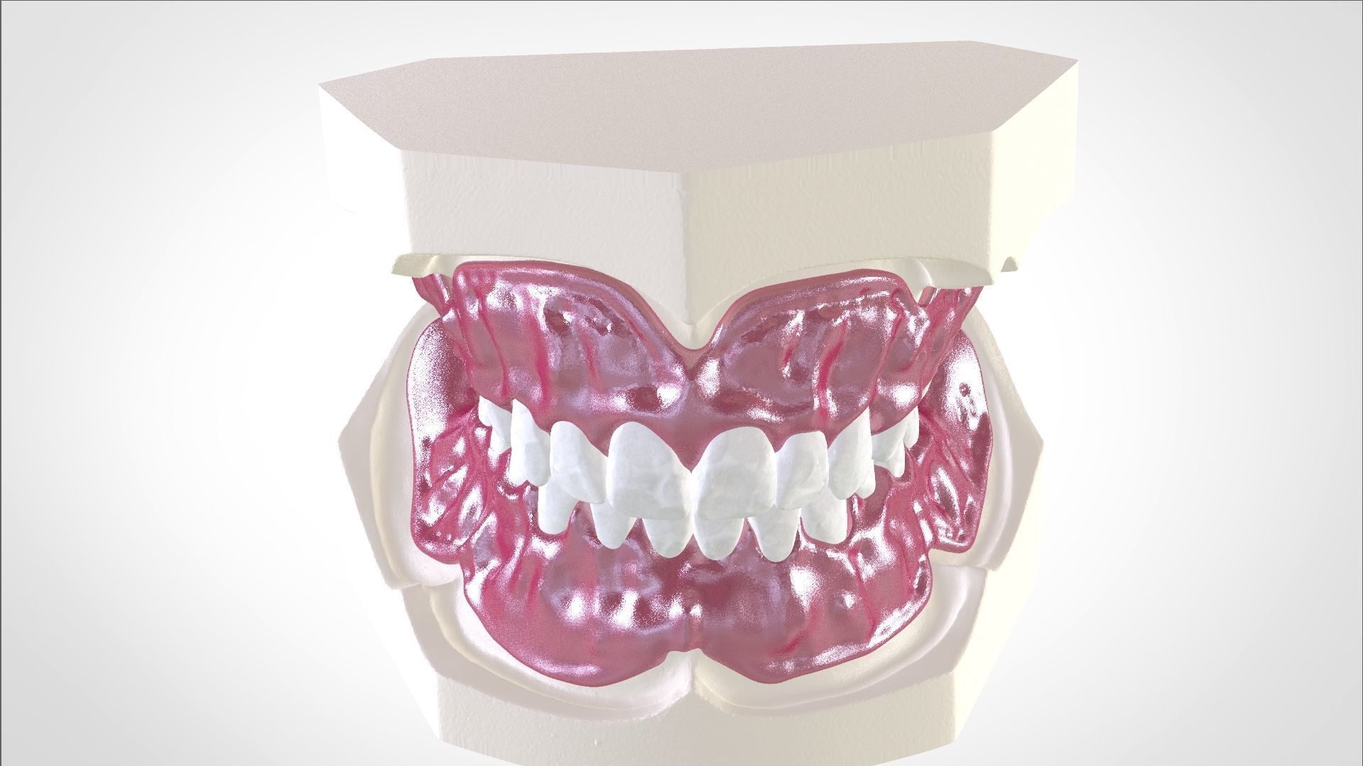 Digital Full Dentures for Gluedin Teeth with Manual Reduction 3D print model_9