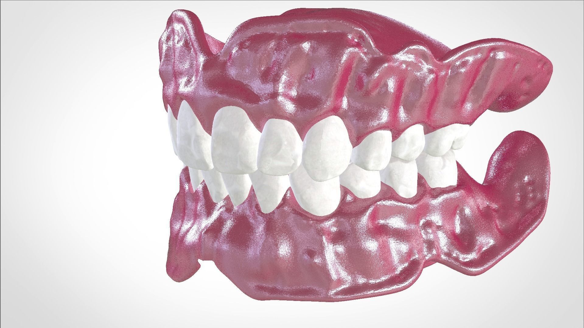 Digital Full Dentures for Gluedin Teeth with Manual Reduction 3D print model_24