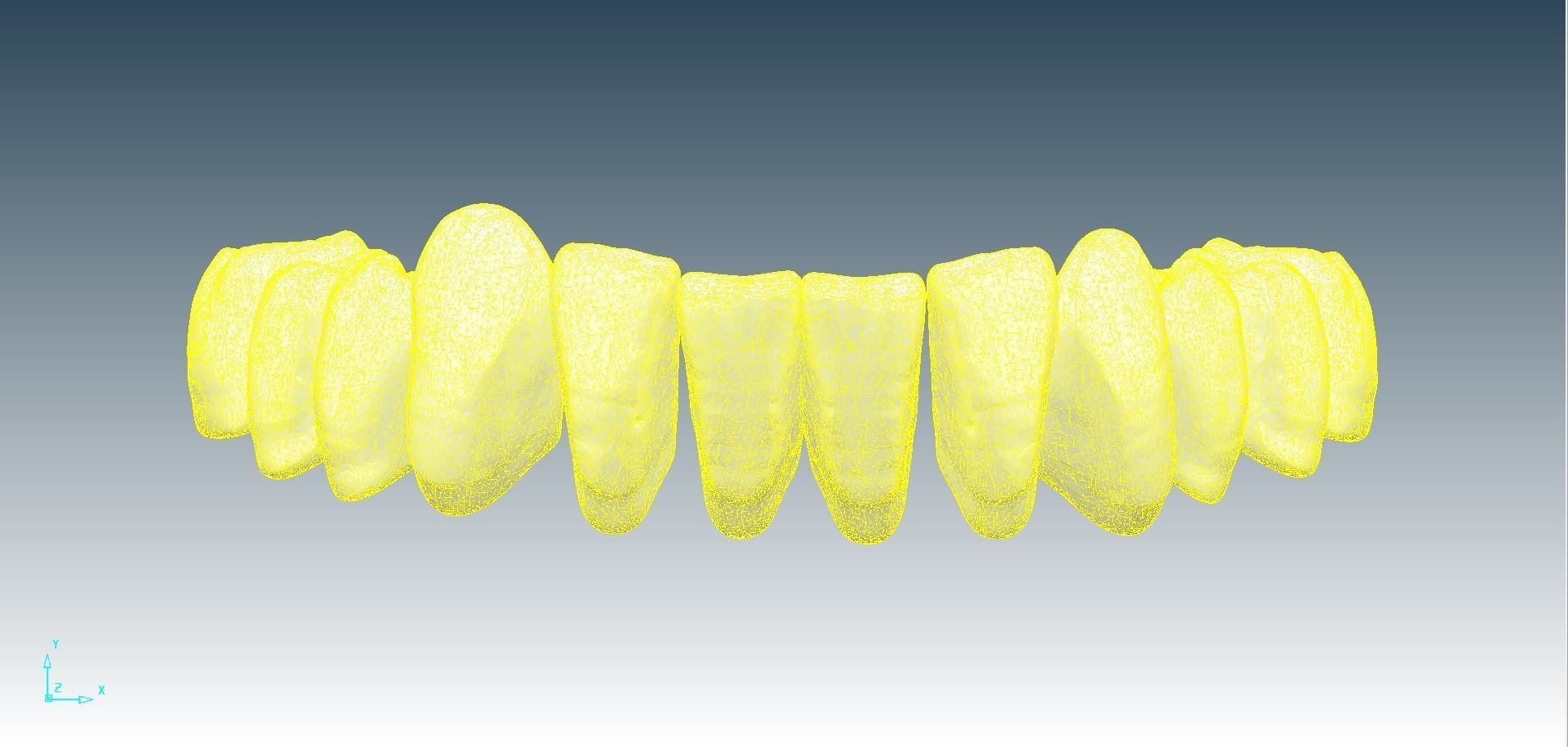 Digital Full Dentures for Gluedin Teeth with Manual Reduction 3D print model_30