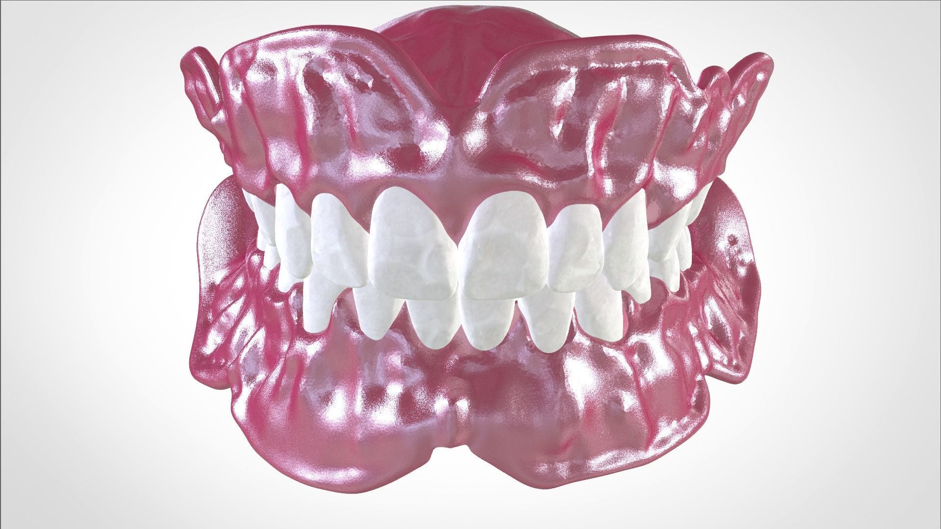 Digital Full Dentures for Gluedin Teeth with Manual Reduction 3D print model_26