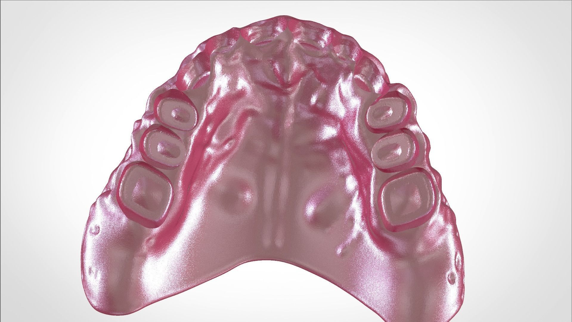 Digital Full Dentures for Gluedin Teeth with Manual Reduction 3D print model_21