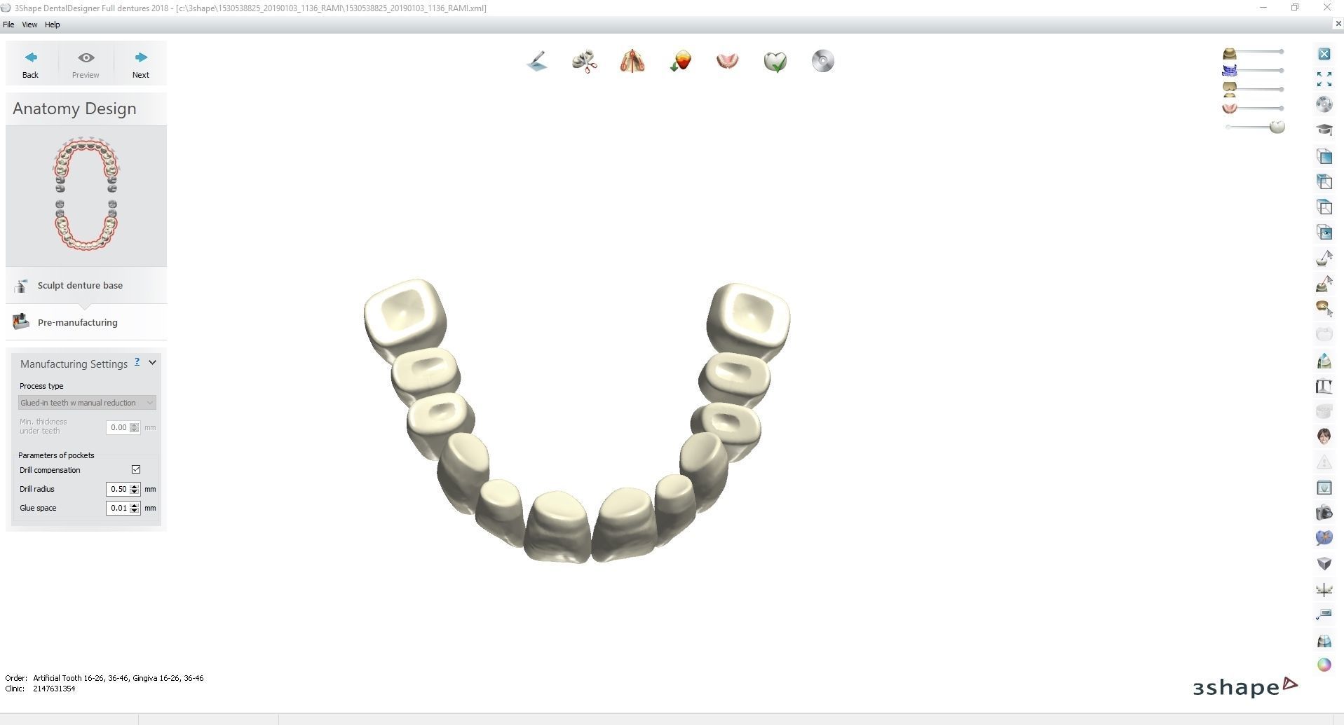 Digital Full Dentures for Gluedin Teeth with Manual Reduction 3D print model_3